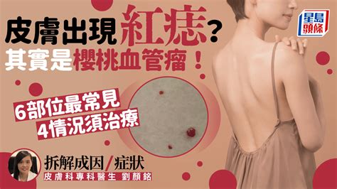 痣流血處理|皮膚突然出現紅痣？其實是櫻桃血管瘤 4情況須治療 醫。